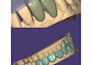 create a high quality digital smile design in exocad first crown free